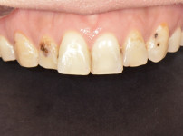 최OO님 상악전치부심미보철(전).jpg