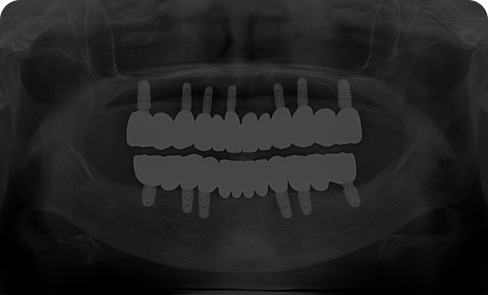 치료 후 임상 사례 1