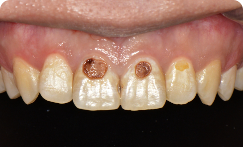 치료 전 임상 사례 2